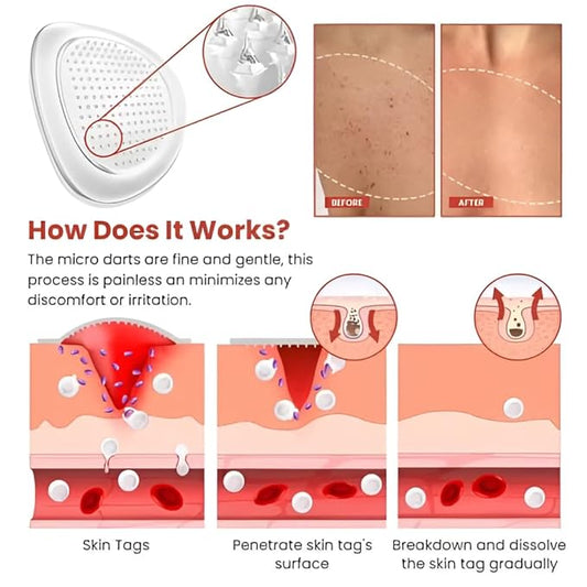 Derma Smooth Skin Tag Removal Patch Kashio Fast Acting Painless Skin Tag and Mole Remover Patch Natural Formula for Clear Smooth Skin Safe for All Skin Types